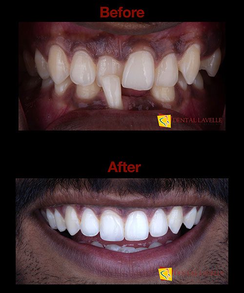 Invisalign Treatment Before vs After