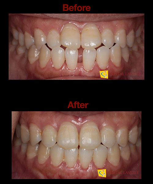 Invisalign Treatment Before vs After