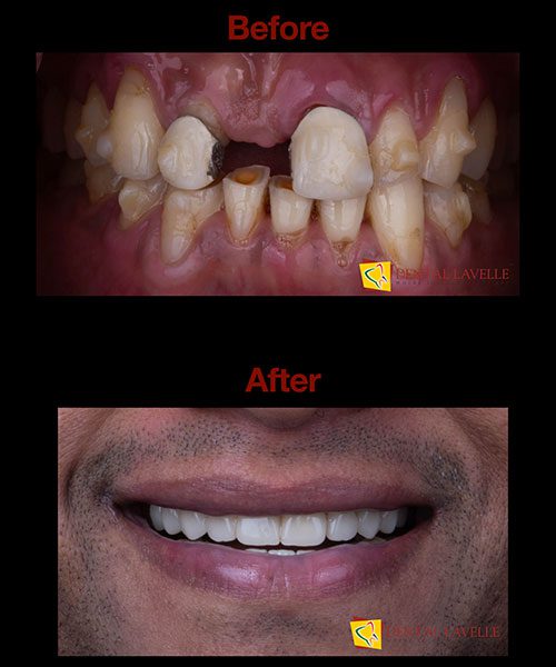Invisalign Treatment Before vs After