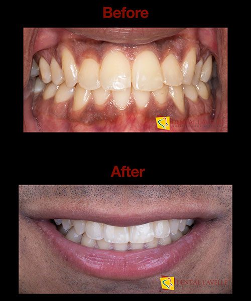 Invisalign Treatment Before vs After