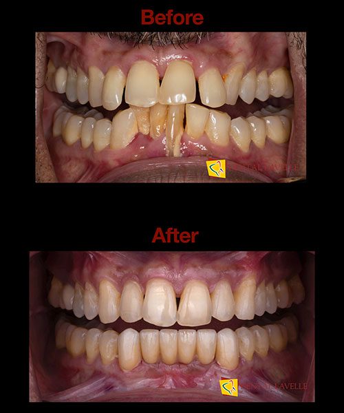 Smile Makeover Before vs After