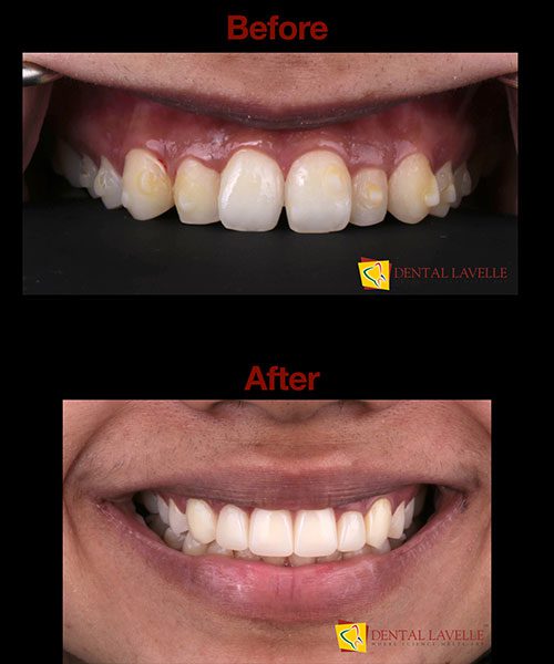Smile Makeover Before vs After
