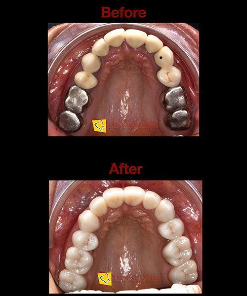 Smile Makeover Before vs After