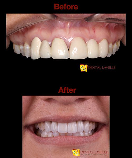 Smile Makeover Before vs After
