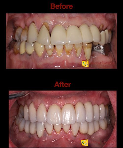 Smile Makeover Before vs After