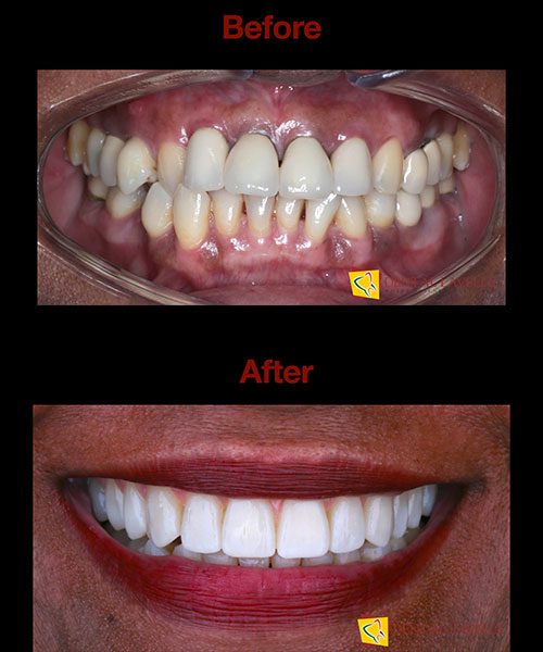 Smile Makeover Before vs After