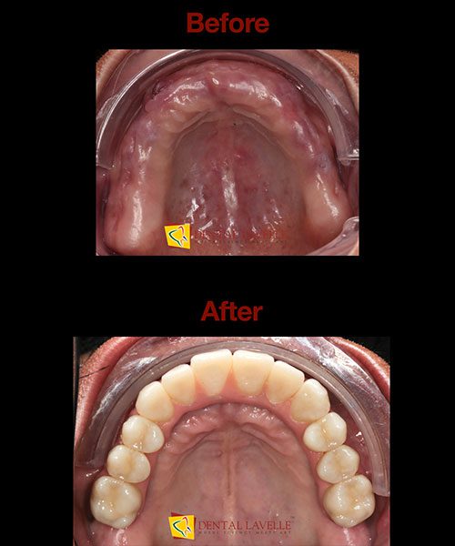 Smile Makeover Before vs After