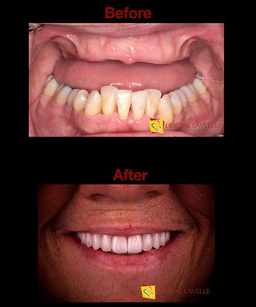 Smile Makeover Before vs After