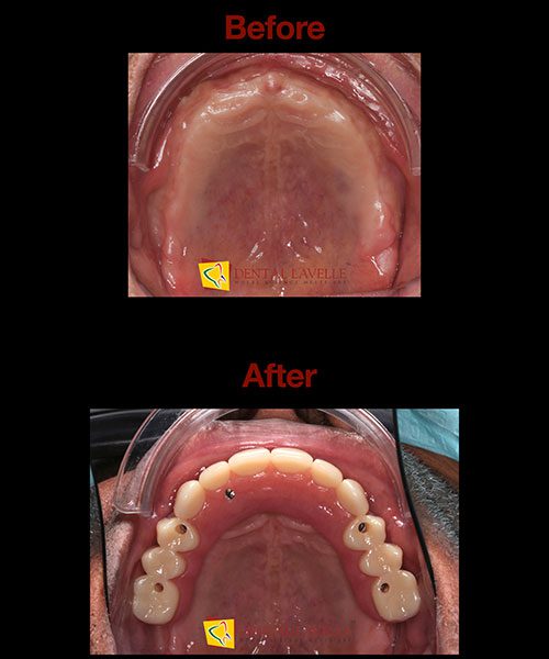 Smile Makeover Before vs After