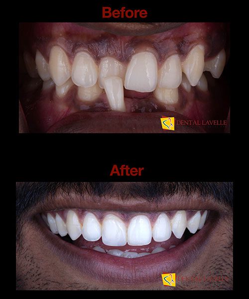 Smile Makeover Before vs After