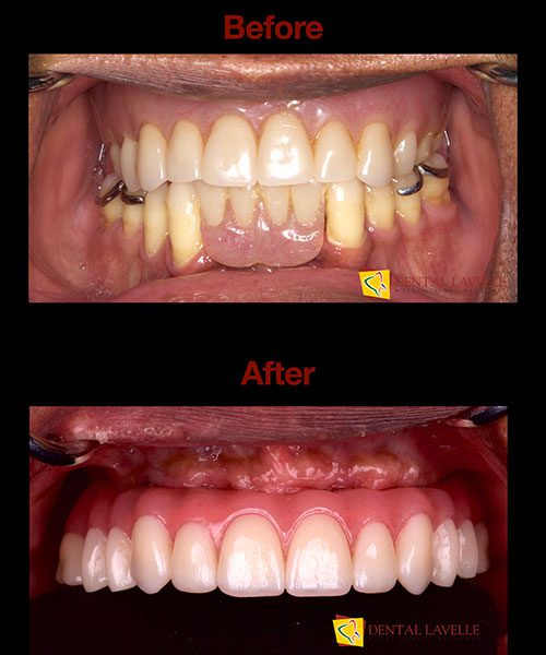 Smile Makeover Before vs After