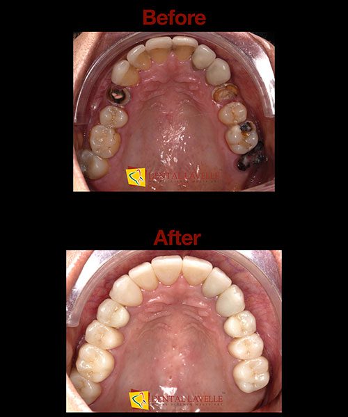 Smile Makeover Before vs After
