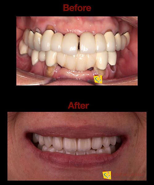 Smile Makeover Before vs After