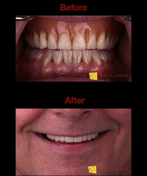 Smile Makeover Before vs After