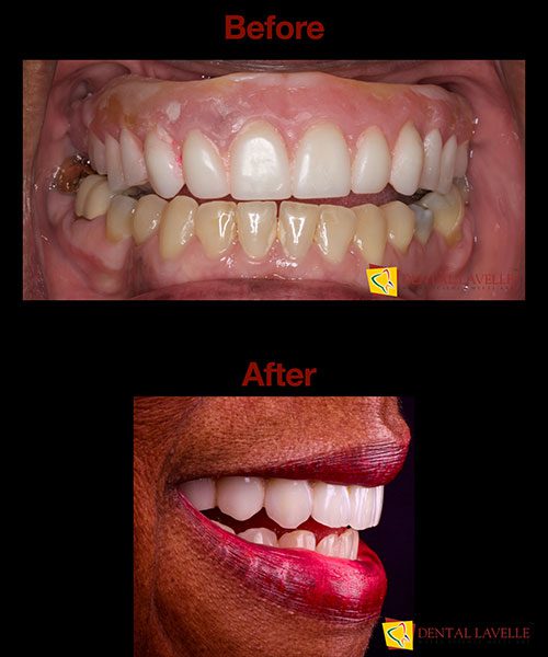Smile Makeover Before vs After