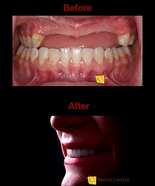 Smile Makeover Before vs After