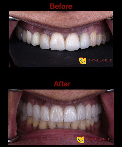 Smile Makeover Before vs After