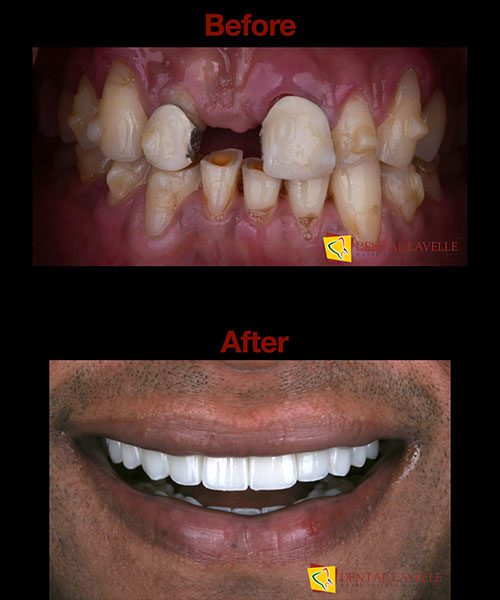 Smile Makeover Before vs After