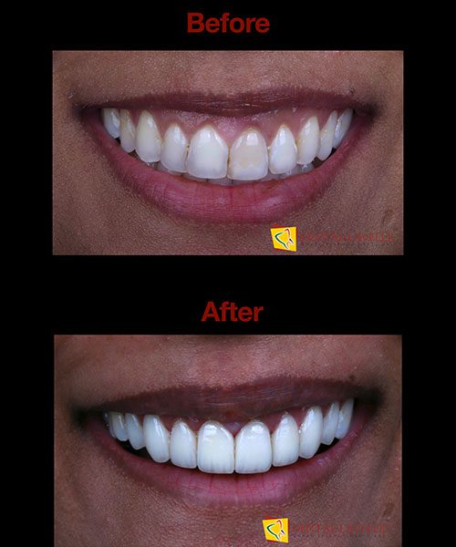 Smile Makeover Before vs After