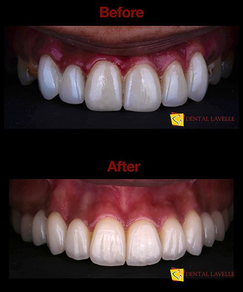 Smile Makeover Before vs After