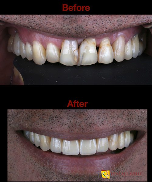Smile Makeover Before vs After