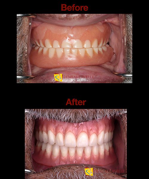 Smile Makeover Before vs After