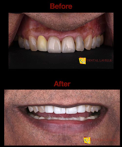 Smile Makeover Before vs After